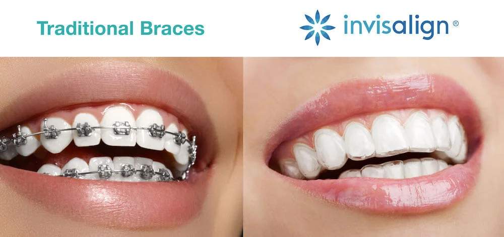  Tìm hiểu khái quát về niềng răng Invisalign là gì? 