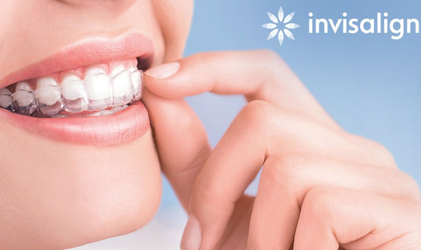 Niềng răng Invisalign mang lại hiệu quả tối ưu